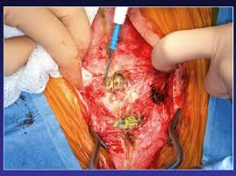REDO CARDIAC SURGERIES